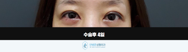 상하안검수술 필요한 순간 위아래 눈꺼풀을 함께 보는 이유 관련 이미지 4
