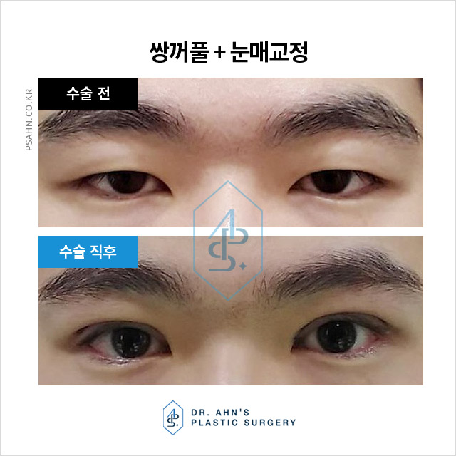 사회적 자신감과 인상 개선을 위한 남성 쌍꺼풀 수술 관련 이미지 4
