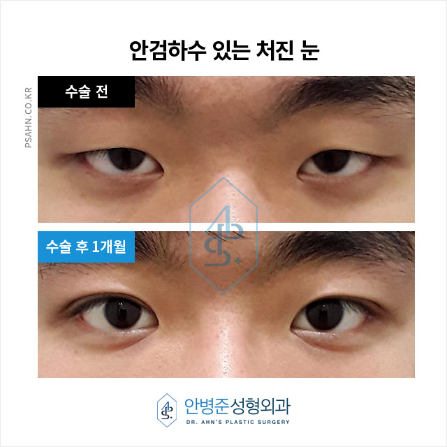 [남자눈성형] 남자 쌍꺼풀, 여자와 다른 자연스러움의 포인트? 관련 이미지 4