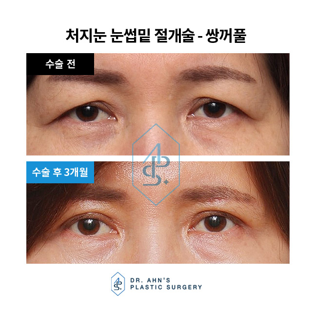 [눈성형] 쌍꺼풀 - 눈밑지방 제거 및 눈밑지방 재배치 관련 이미지 1