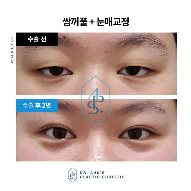 함몰눈,돌출눈 쌍꺼풀 - 눈 형태에 따른 눈성형 방법 관련 이미지 4