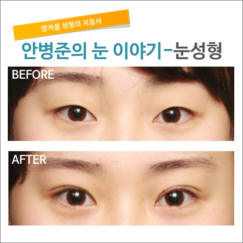 수술후 1개월 경과후&눈감은 모습             [안병준의 눈이야기] 관련 이미지 1