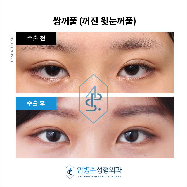 눈두덩이에 지방이 부족하다? 당신은 꺼진눈입니까? 관련 이미지 1