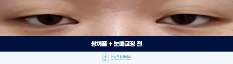 쌍꺼풀 눈매교정 조화롭게 자연스러움과 또렷함을 찾아서 관련 이미지 2