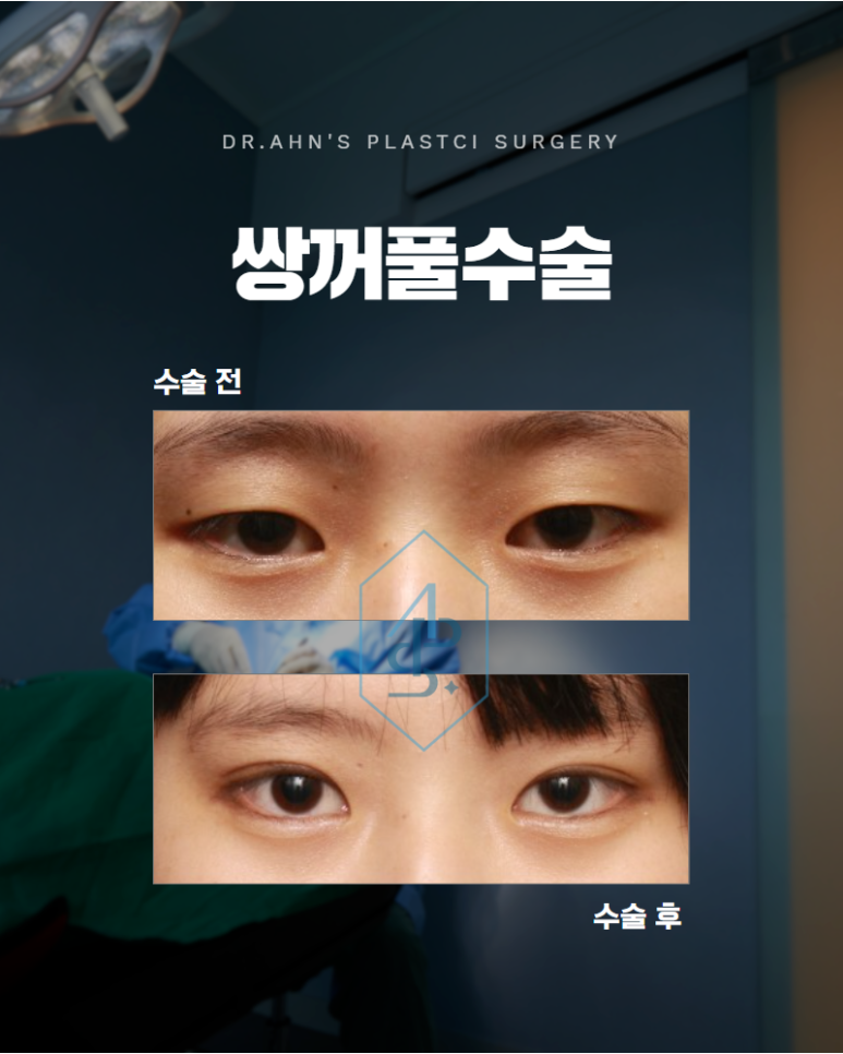쌍꺼풀수술 자연스러운 눈을 만들기 위한 중요한 기준 관련 이미지 1