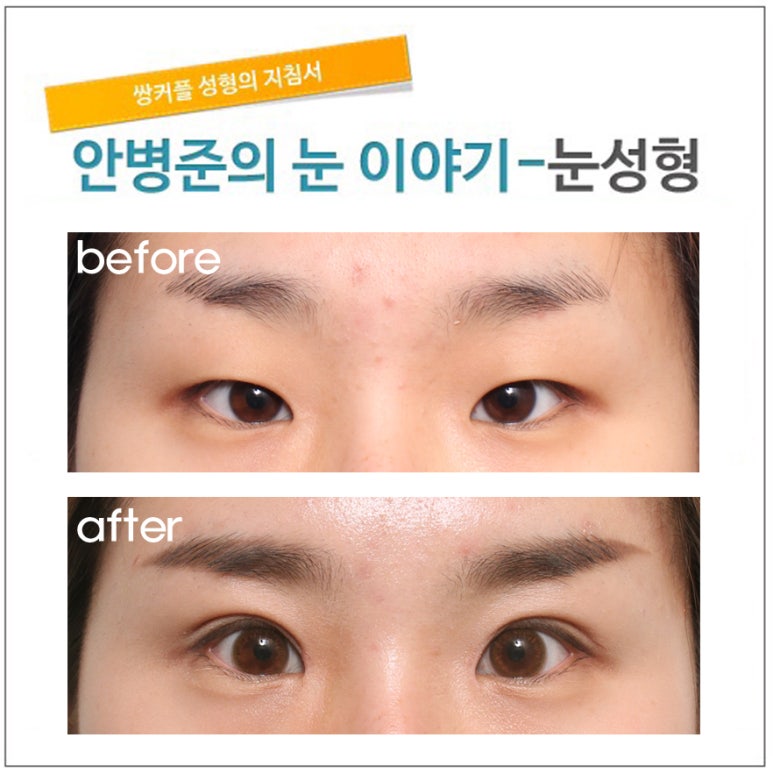 피부 처짐이 있는 경미한 안검하수 관련 이미지 1