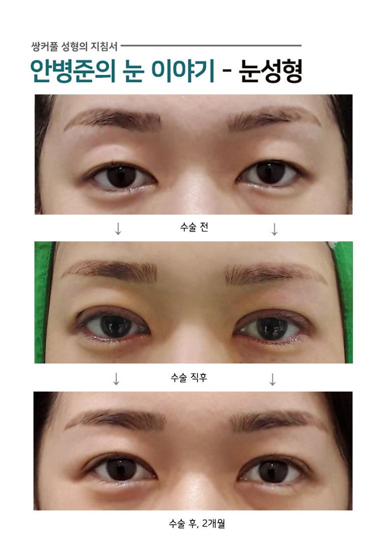 비대칭,짝눈(쌍수,눈매교정) 관련 이미지 1