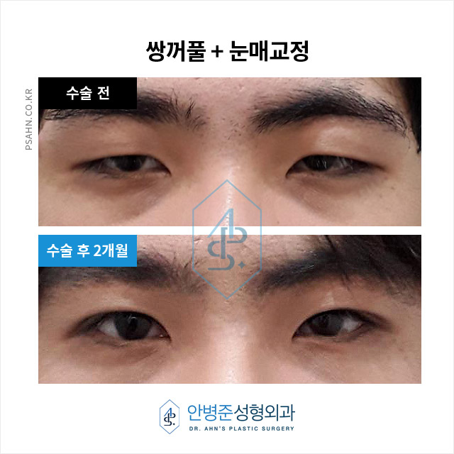 [남자쌍꺼풀]남성 안검하수, 답답함 벗고 활력을 되찾는 눈매 교정 관련 이미지 3
