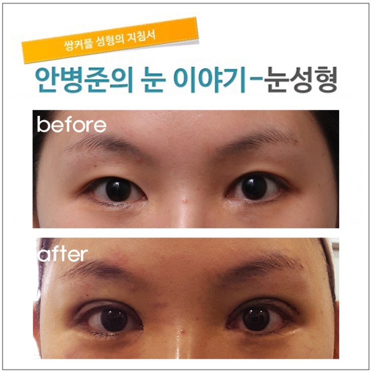 3번의 수술과 앞트임후 복원한 후 다시 4번째 수술.(쌍꺼풀재수술) 관련 이미지 1