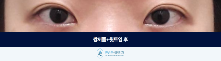 윗트임 가짜안검하수 눈매교정 필요하지 않은 경우 관련 이미지 3