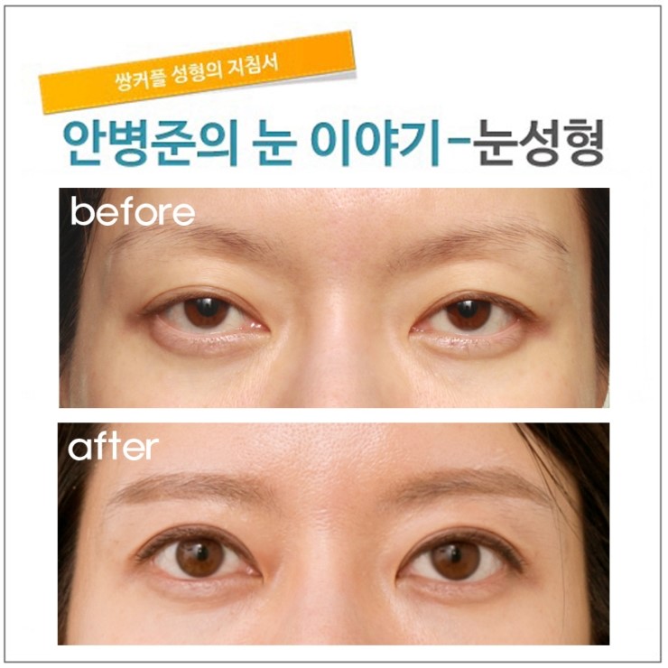 꺼진 눈과 졸린 눈,지방이식 전에 고려해야 할 문제. 관련 이미지 1