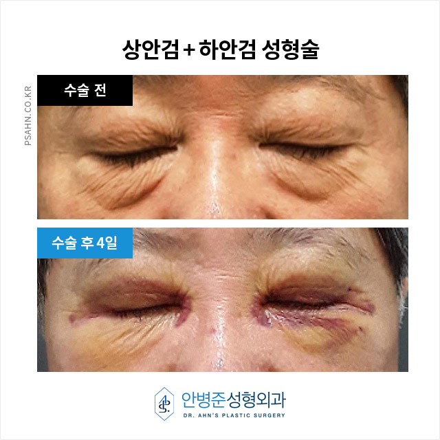 [상안검,하안검]100세 시대, 남성 상하안검성형술의 새로운 관심 관련 이미지 6