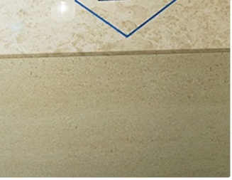 쌍꺼풀재수술 절개법을 이용하여 자연스러운 눈매를 찾다 관련 이미지 16