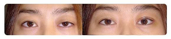 안검하수 눈매교정 가짜와 진짜를 구분해야 합니다 관련 이미지 5