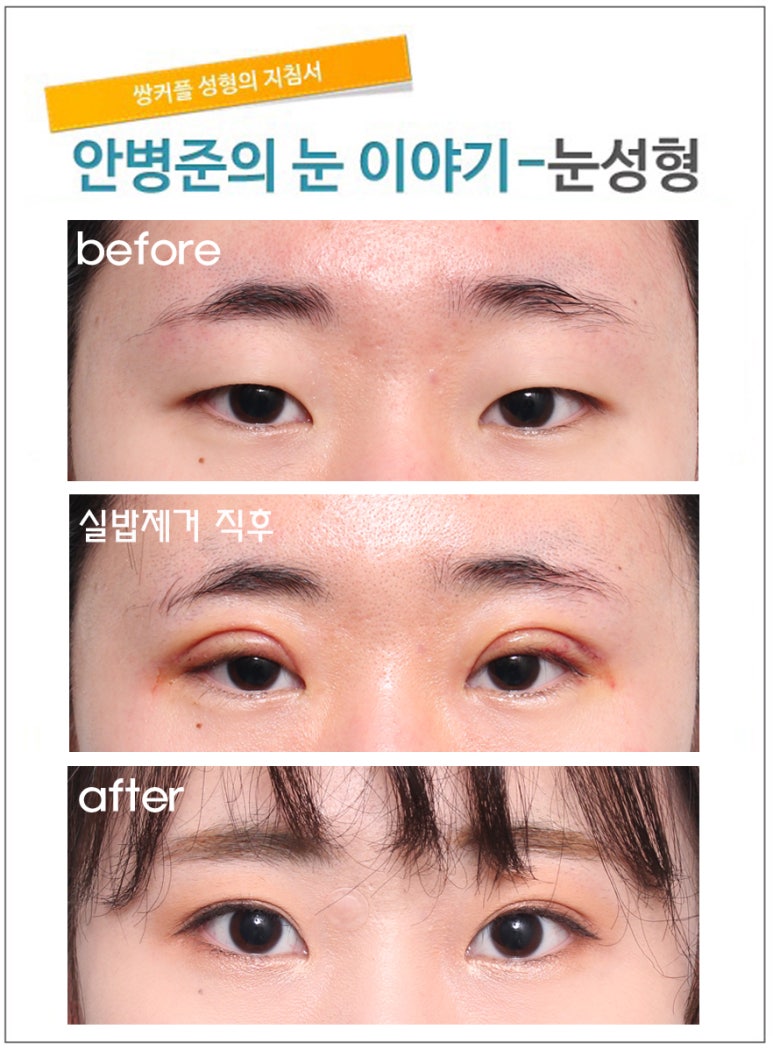 안검하수라 오해 받는 눈(가짜안검하수,가성안검하수) 관련 이미지 1