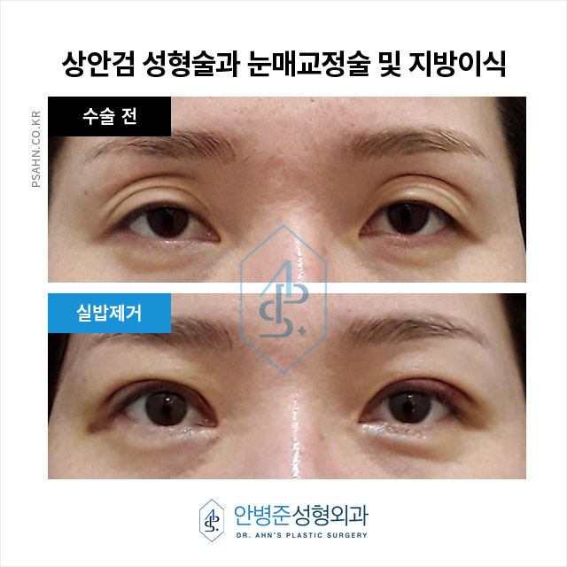 [눈성형]눈꺼풀 피부 처짐과 안와지방 소실 수술 사례 관련 이미지 2