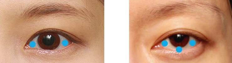 삼백안의 정확한 설명(삼백안,피부절제,안검하수) 관련 이미지 1