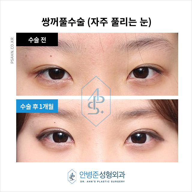 [쌍수성형외과] 몽고주름 개선으로 또렷해지는 자연 쌍꺼풀 라인 관련 이미지 1