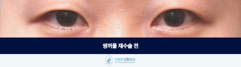 If Your Double Eyelid Line Has Become Hidden Over Time: Revision Surgery image 2