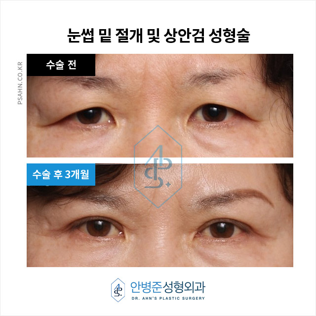[강남역성형외과] 눈썹거상술? 눈썹밑절제술? 눈밑지방재배치? 관련 이미지 2