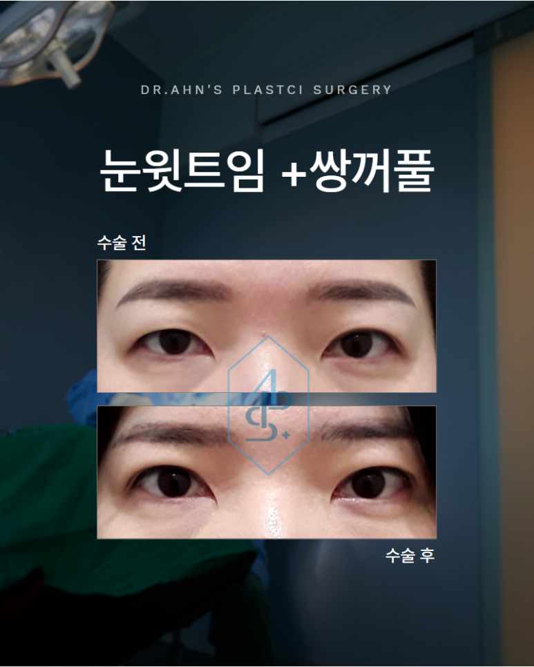 눈윗트임 쌍꺼풀 안검하수라고 섣불리 눈매교정하기보다는 관련 이미지 1