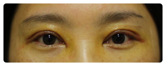 -소시지눈 고치기 과정-        [안병준의 눈이야기] 관련 이미지 10