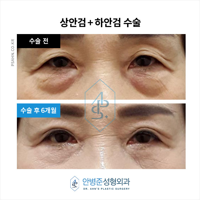 상&middot;하안검수술,안전하고 자연스러운 결과를 위한 선택 관련 이미지 5