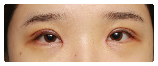 쌍커풀수술 4개월째 경과 관련 이미지 2