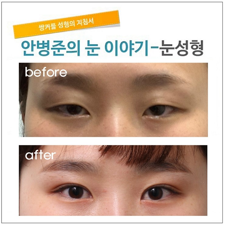 자주보는 졸린눈.(피부절제,눈매교정,절개법) 관련 이미지 1