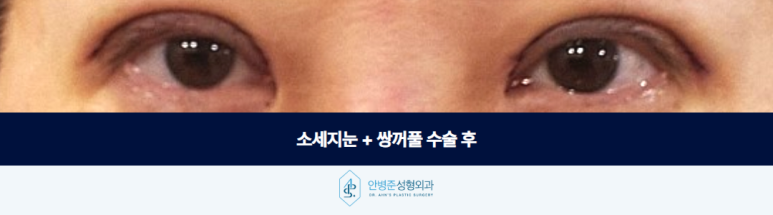 소세지눈 쌍꺼풀 크고 자연스러운 라인은 없습니다 관련 이미지 3