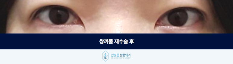 쌍꺼풀 재수술 가짜 안검하수 눈매교정이 필요 없는 눈은 어떻게 구분할까 관련 이미지 3