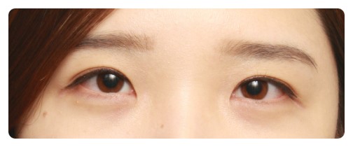 쌍커풀수술 4개월째 경과 관련 이미지 4