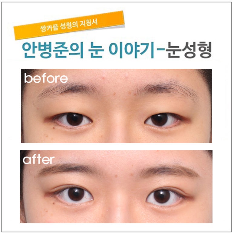 전형적인 동양눈(쌍꺼풀수술,기본쌍꺼풀수술,절개법) 관련 이미지 1