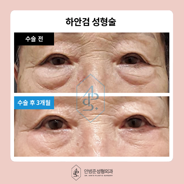 [눈성형]50대도 동안 유지! 상안검&하안검 성형으로 자신감 찾기 관련 이미지 7