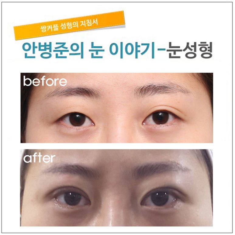 부분절개(절개법,매몰법과 절개법 차이,매몰법) 관련 이미지 1