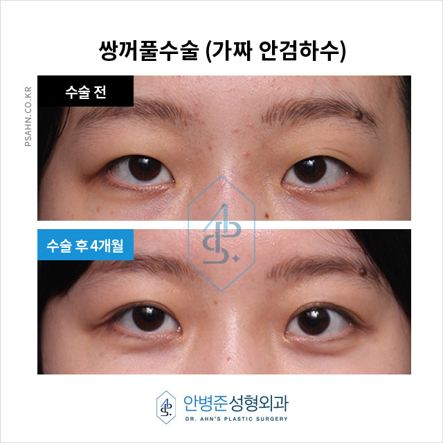 [가짜안검하수] 자연스러운 눈매를 위한 쌍꺼풀 수술과 피부 처짐 개선 효과 관련 이미지 3