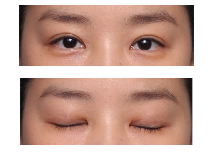 대표적인 단순 쌍꺼풀 수술.(쌍꺼풀수술,기본쌍꺼풀수술,자연스러운쌍꺼풀) 관련 이미지 4