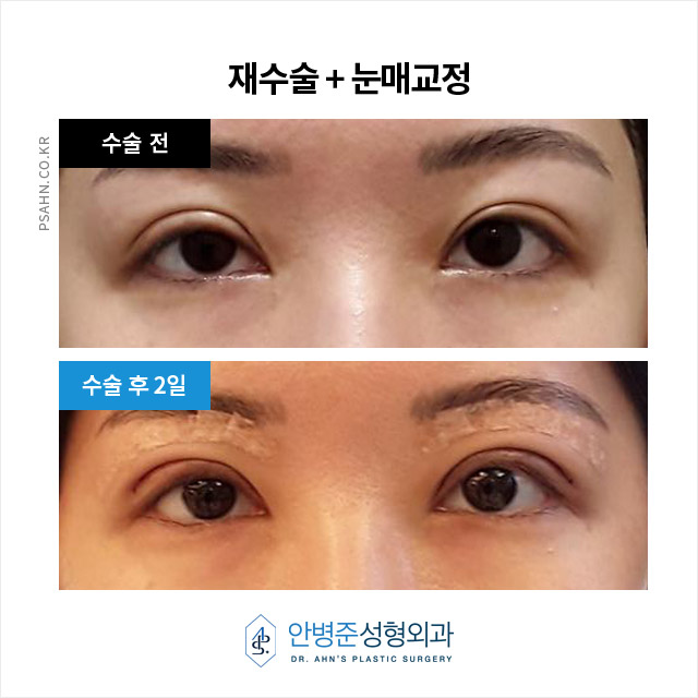 [눈재수술]  두 번의 눈 재수술, 4년간의 관련 이미지 2