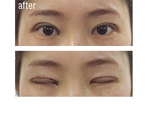 두겹 쌍꺼풀 라인 정리. 관련 이미지 2