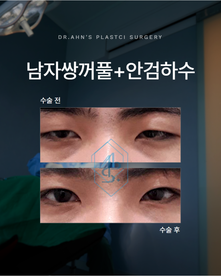 남자쌍꺼풀 안검하수 졸려 보이는 인상 눈 뜨는 힘부터 확인해야 합니다 관련 이미지 1