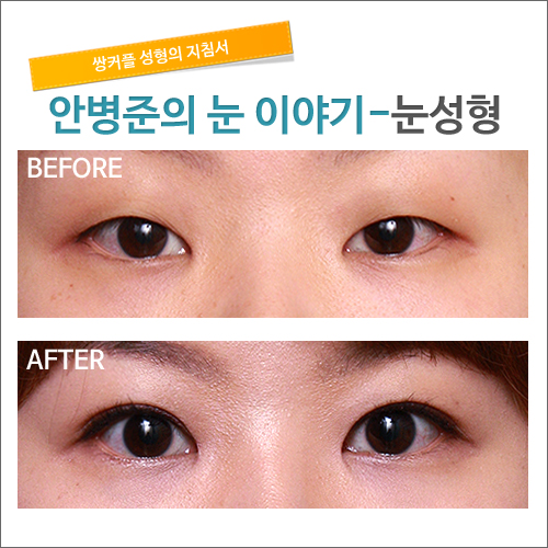쌍꺼풀이란?_시크릿 성형외과 안병준의 쌍꺼풀 지침서 관련 이미지 3