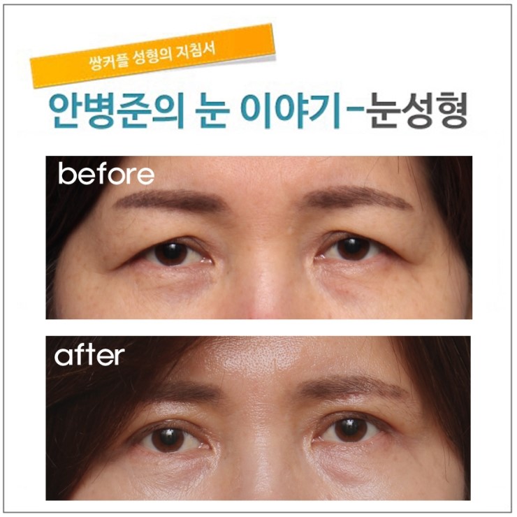 상안검성형술과 눈썹밑 절개술 관련 이미지 1