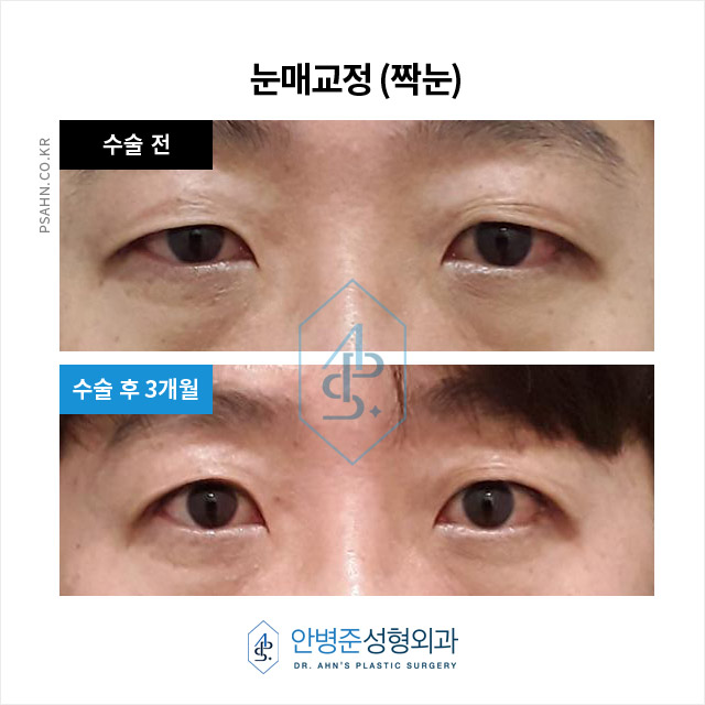 [짝눈성형]남자 짝눈 교정, 단순 쌍수로는 부족한 이유 관련 이미지 3