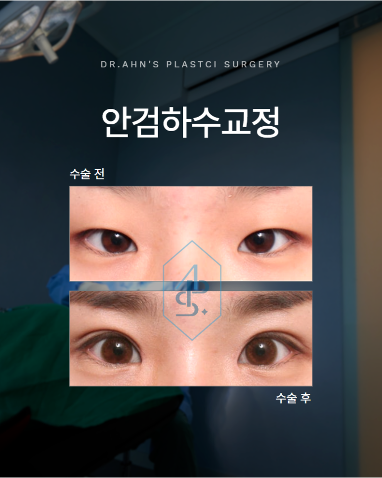 Before Correcting Ptosis, You Must First Determine Whether Skin Sagging Is the Cause image 1