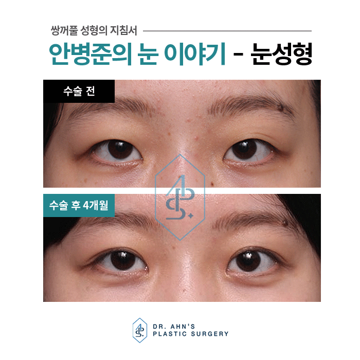 [안검하수성형외과] 잘못 알고 있는 가짜 안검하수 관련 이미지 2