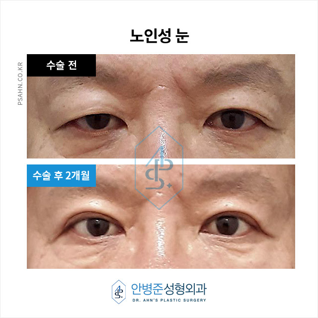 [남자눈성형] 남자 쌍꺼풀, 여자와 다른 자연스러움의 포인트? 관련 이미지 7