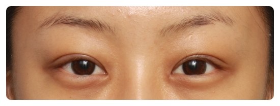 [안병준의 눈이야기]-안병준 성형외과 관련 이미지 4