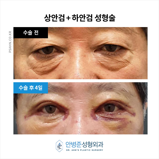 [상안검,하안검]100세 시대, 남성 상하안검성형술의 새로운 관심 관련 이미지 5