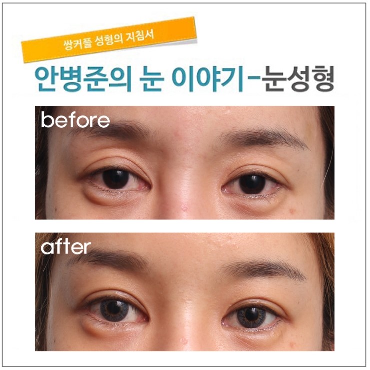 꺼진 눈꺼풀 지방이식(재수술) 관련 이미지 1