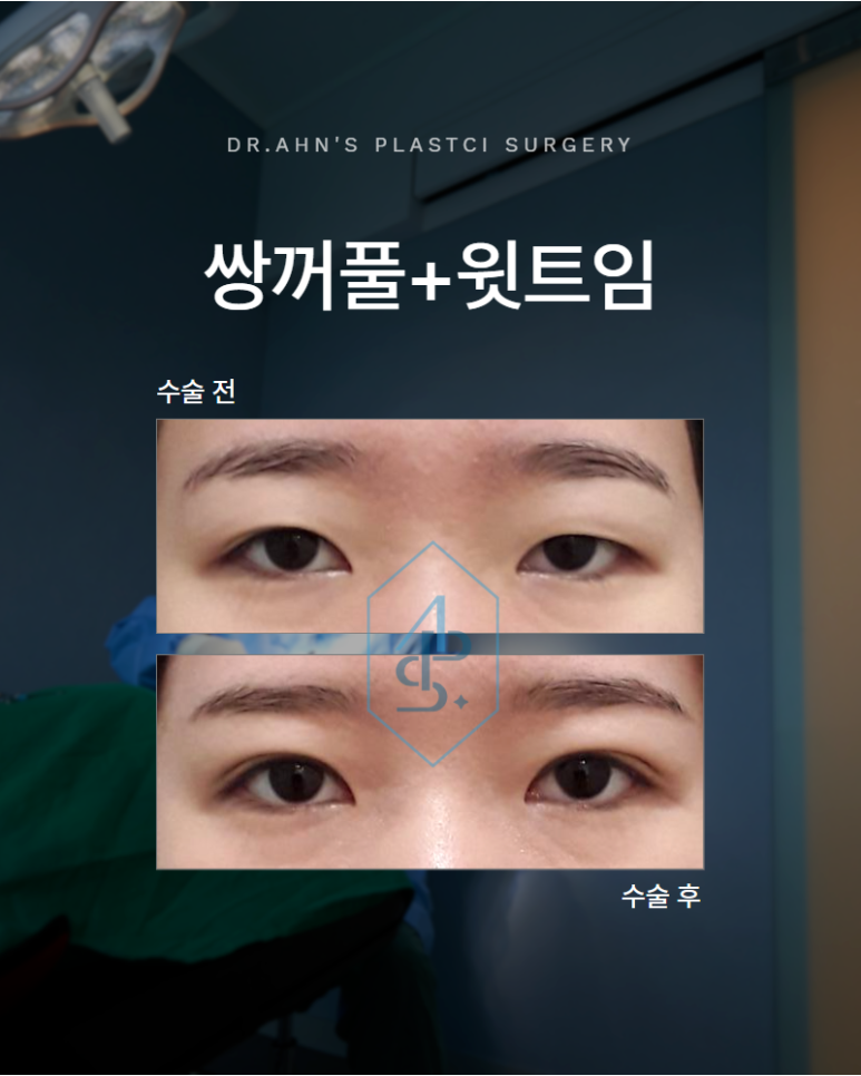 쌍꺼풀 윗트임 가짜 안검하수 판단하기 전에 알아야 할 것 관련 이미지 1